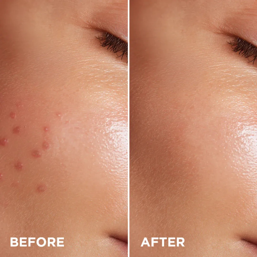 Eveline Super Duet 10% Zinc & Salicylic Acid Anti-Blemish Serum - 18ml